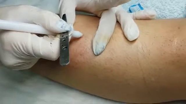 За работой...электроэпиляции голени... Светлана Яковенко смотреть онлайн