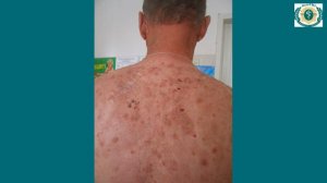 Акантолитическая пузырчатка