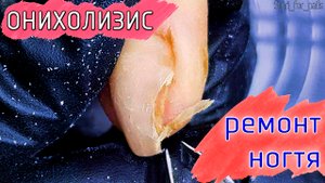 онихолизис протезирование и ремонт гелем.mp4