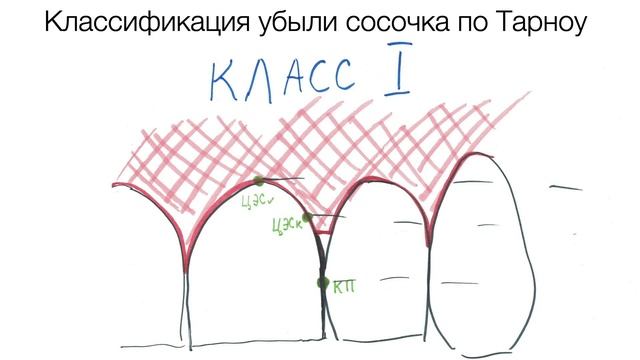 Хирургическое лечение рецессии десны 1.2 смотреть онлайн