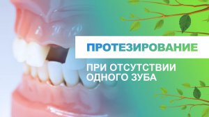 ? Протезирование при отсутствии одного зуба - какие варианты?