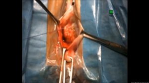 Пластика цистоцеле. Супрафасциальная техника.