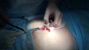 Оперативное лечение пупочной грыжи в Уфе