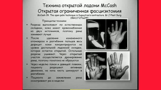 Контрактура дюпюитрена смотреть онлайн