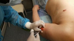 Удаление множественных липом бригадой из двух хирургов