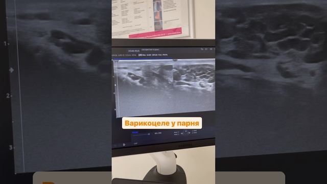 Варикоцеле у парня. Риск бесплодия. Эректильная дисфункция. Сосудистый хирург. Флеболог Москва