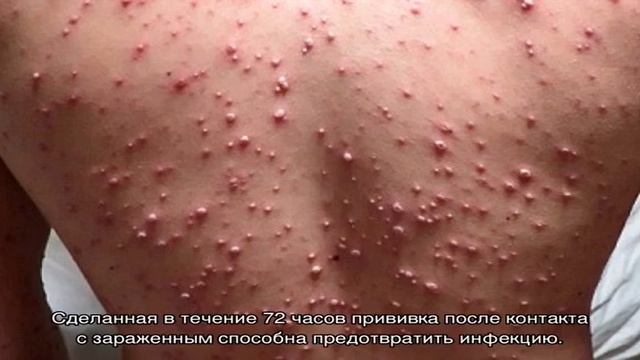 Профилактика ветрянки