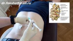 Лечение ОСТЕОХОНДРОЗА БЛОКАДА Paravertebral Block