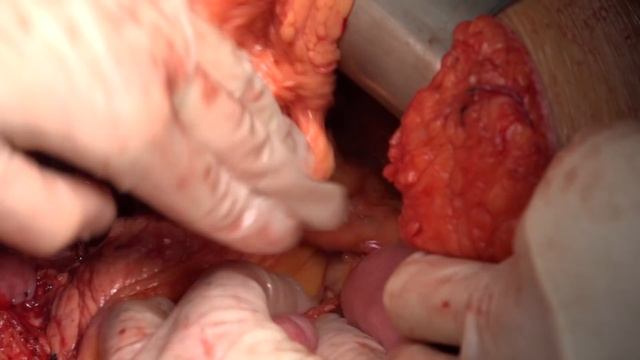 Open totall gastrectomy D2 for gastric cancer ypT3N3aM0 смотреть онлайн