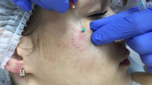 Мезонити в области малярных мешков - ДекусМедика