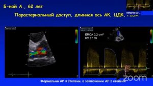 Эхокардиография в оценке выраженности регургитаций