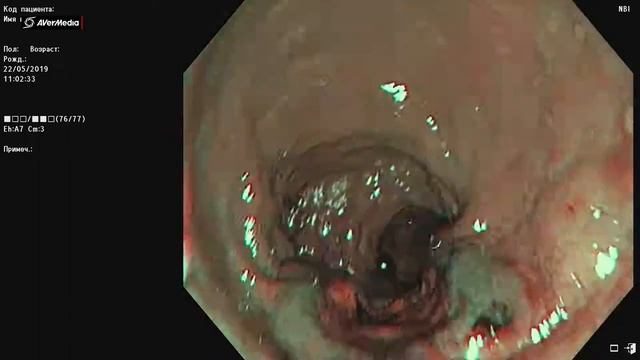 Колоноскопия. Опухоль прямой кишки. смотреть онлайн