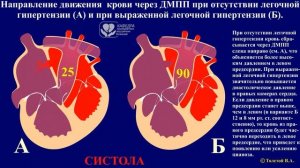 ВПС. Дефект межпредсердной перегородки.