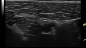 УЗИ: аппендикс на всем протяжении