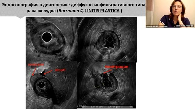 Возможности эндосонографии онкологических заболеваний пищеварительной системы