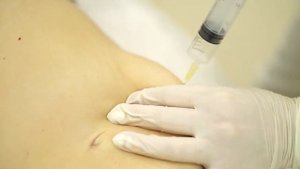 Озонотерапия.