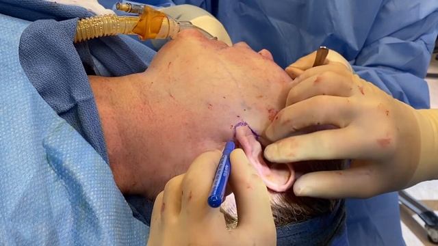 UNBOTCHED Ep. 23: The Anti-Aging Facelift