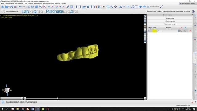 Про шаблоны. 2 имплантата. Подробный разбор. смотреть онлайн
