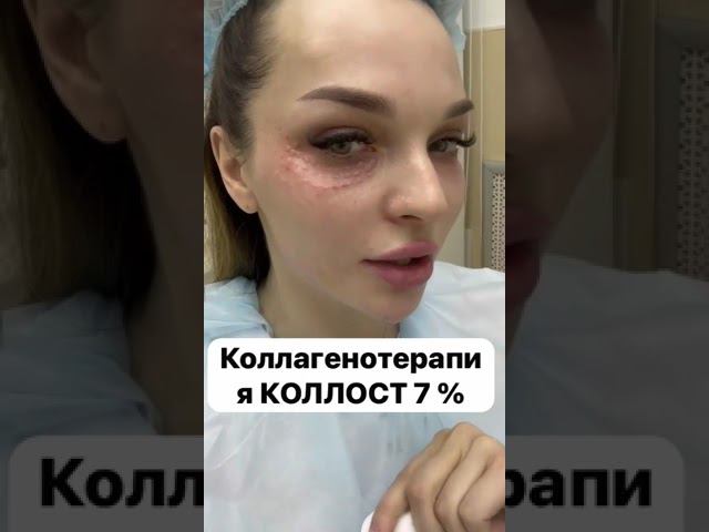 Коллагенотерапия Коллост 7% #skincare #коллаген