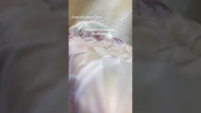Работали без анестезии . Сразу после #электроэпиляциямосква #электроэпиляция