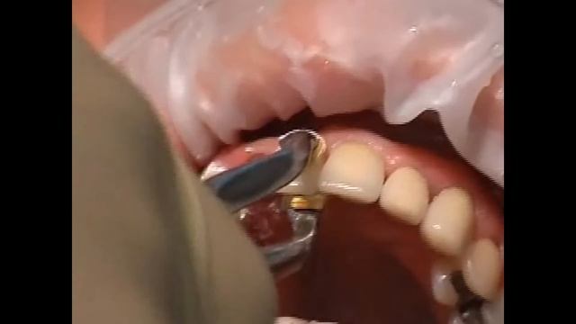 Титановый абатмент смотреть онлайн