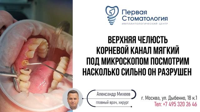 Спасение клыка из-за подвижности моста.