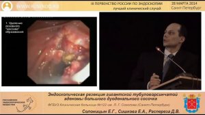 Эндоскопическая резекция гигантской тубуловорсинчатой аденомы большого дуоденального сосочка