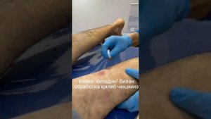 Варико ни Лазер билан даволаганда эртанги кундаги куруви. Лазер Варикозни даволашни энг яхшиси