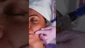 Терапевтический лифтинг овала лица жидкими нитями DERLI FIBROLIFT STRONG