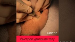 Удаление татуировки лазером. Как удалить татуировку быстро?