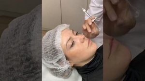 Контурная пластика тонких губ