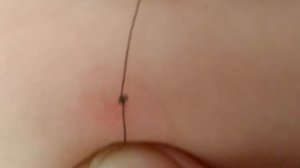 Как удалить клеща ниткой