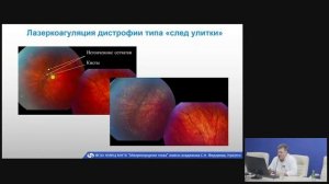 Периферические витреохориоретинальные дистрофии сетчатки.mp4