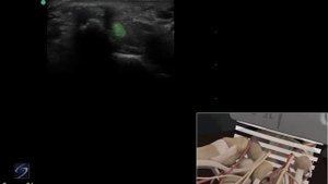 3D-пособие: ультразвуковое исследование ладонной поверхности лучезапястного сустава — SonoSite