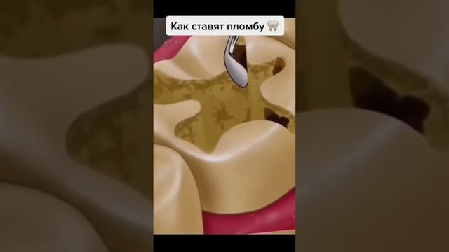 КАК НА САМОМ ДЕЛЕ ТЕБЕ СТАВЯТ ПЛОМБУ НА ЗУБЫ???