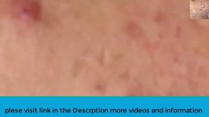 Make your Acne Treatment | Acne  spa  776 | Acne  spa Treatment