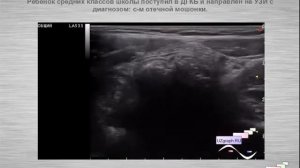 Лекция: Паховая грыжа в практике детского врача ультразвуковой диагностики (УЗД)