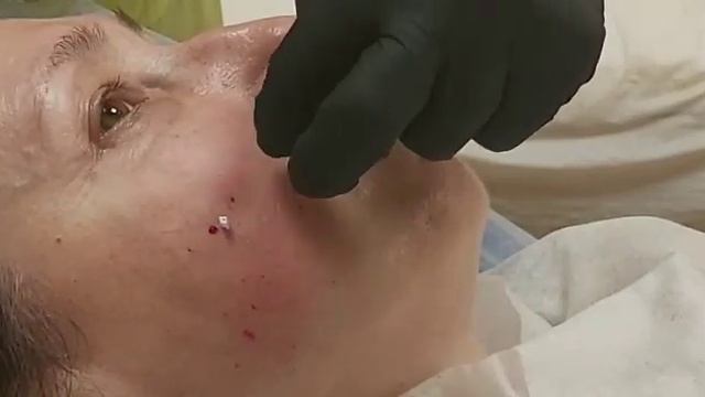 АирисКом студенты учатся: семинар по применению мезонитей для коррекции области щёк и носогубки. смотреть онлайн