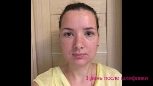 Лазерная шлифовка постакне