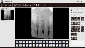 Refine Визиограф R1/R2 как измерить и пометить рентгенологическое изображение зубов