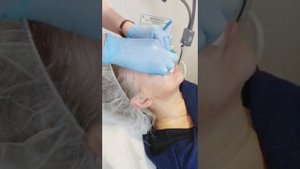 Yellow  peel 3- Retises CT