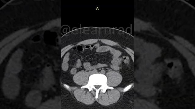 Ureter stones