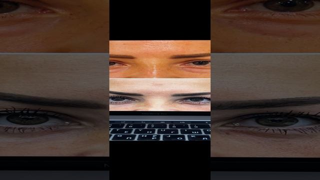Нижняя трансконьюнктивальная блефаропластика. Несколько лет после операции.