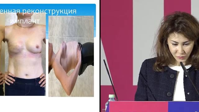Реконструкция молочной железы собственными тканями (TRAM, DIEP лоскут) смотреть онлайн