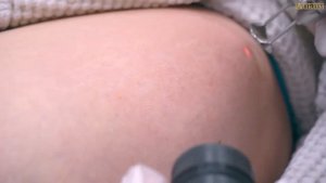 Лазерное удаление растяжек