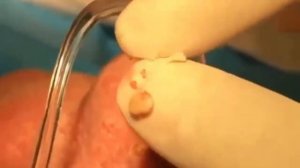 Чистка лица. Прыщи, угри и чёрные точки. Face cleaning. Pimples, blackheads, and black dots.