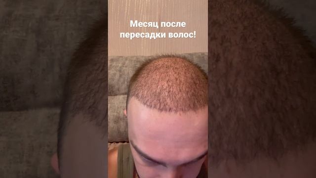 Спустя 30 дней после пересадки волос. #пересадкаволос #стамбул #hair #hairstyle