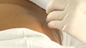 Наружная холангиостомия