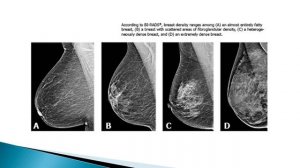 Breast Density