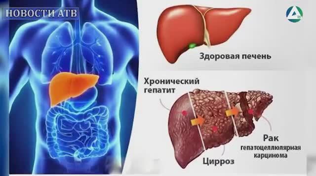 О ситуации с гепатитами в Асбесте, АТВ